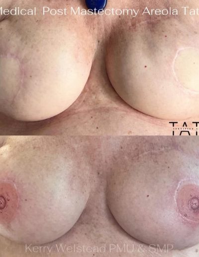 Areola Tattooing - Medical & Cosmetic - Kerry Welstead Permanent Makeup & Aesthetics